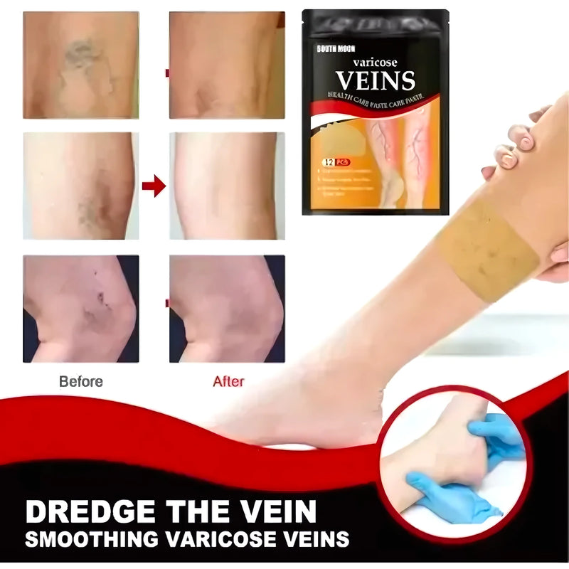 Parche Varices X2Pack - Varietas Chile - Santiago