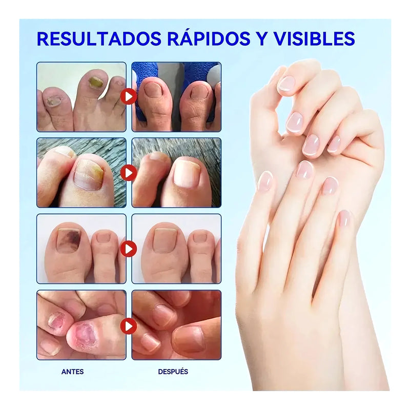 Parches Para Hongos En Uñas De Pies 21Pc - Varietas Chile - Santiago